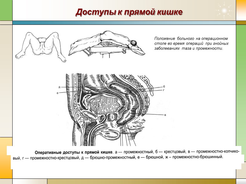 Доступы к прямой кишке Положение больного на операционном столе во время операций при гнойных